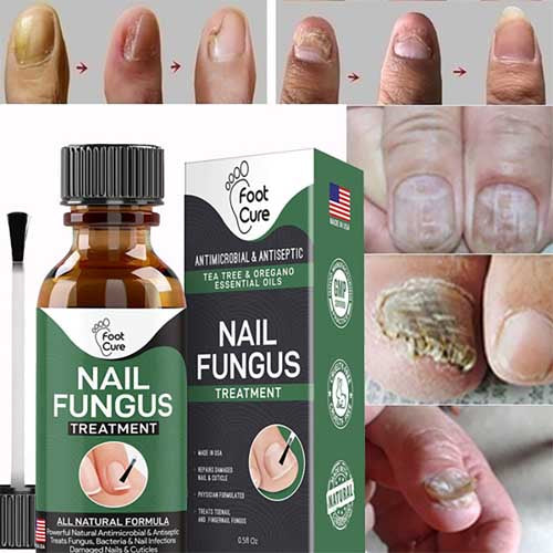 Original Nail Fungus Treatment Stop Fungal Growth Effective Fingernail 10ml